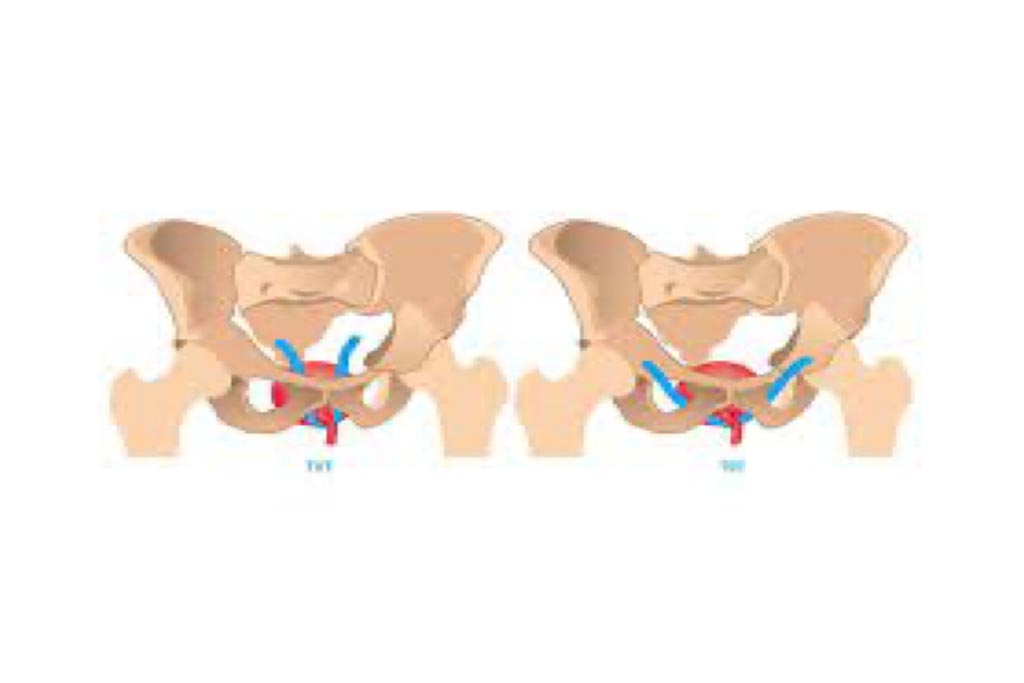 Urogynecological Cases (Tot - TVT)